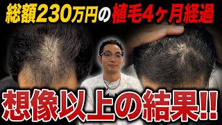 【総額230万円】植毛から4ヶ月経過した状態が驚きの結果に...！