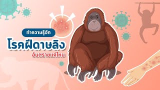 ฝีดาษลิง รู้ระวังไม่ตื่นตระหนก