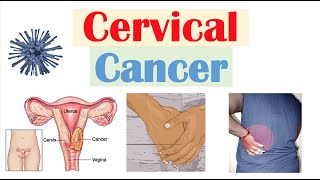 Cervical Cancer: Risk Factors, Pathophysiology, Symptoms, Staging, Diagnosis, Treatment & Prevention