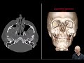 zmc fracture