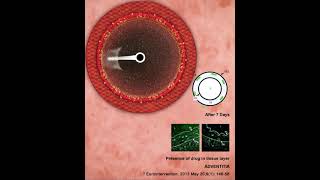 Treatment of Dysfunctional Arteriovenous Fistula and Graft -  Drug-Coated Balloon - MagicTouch AVF