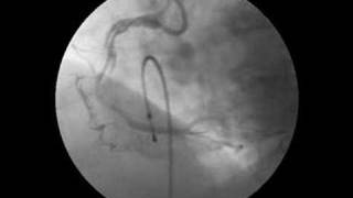 Spiral dissection of Right Coronary Artery