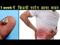 1 week में किडनी स्टोन आया बाहर | Kidney Stone | Shikha Himachali |