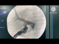 EUS guided Choledochoduodenostomy - TWFC