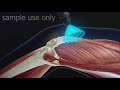 shockwave therapy 3d medical animation sample use only