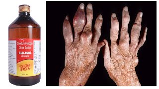 Alkasol Solution = Treatment of Gout | गठिया रोग को ठीक करने करने वाली दवाई | यूरिन के pH को बदले