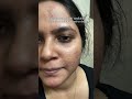 *The unreal Skin Transformation* Hit subscribe #skincare #acne #trendingshorts #clearskin #kurti