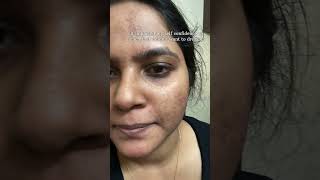 *The unreal Skin Transformation* Hit subscribe #skincare #acne #trendingshorts #clearskin #kurti