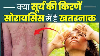 क्या सूरज की रोशनी से सोरायसिस बढ़ता है? Myths About Psoriasis | Sun Light Bath For Psoriasis