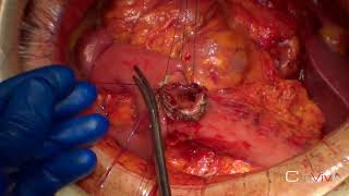 Open Gastrojejunostomy - Live Surgery