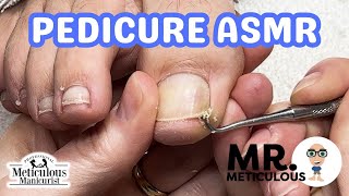 👣ASMR Pedicure Cleaning💆‍♀️ Epic Impacted Toenail Debris Removal on Mr. Meticulous👣