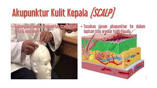 Tahukah Kenapa AKUPUNKTUR Pilihan Terapi Terbaik?