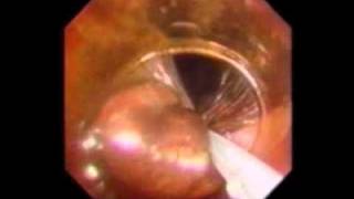 Endoscopic Mucosal Resection for Entire Gastrointestinal Mucosal Lesions