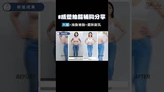 大腿環抽案例大解析！大腿環抽+抽脂補胸+擺脫副乳 #shorts #大腿環抽 #自體補胸 #副乳抽脂 #威塑抽脂 #抽脂手術 #自體脂肪移植 #自體脂肪隆乳 #自體脂肪豐胸 #脂肪槍 #周杰醫師