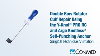 Double Row Rotator Cuff Repair Using Y-Knot® PRO RC and Argo Knotless® Self-Punching Anchor - CONMED