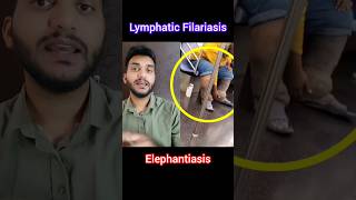 Lymphatic Filariasis #Elephantiasis #shorts @pna1