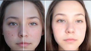 🌟 Acne-Free Skin Secrets: Eskinol \u0026 Clindamycin Transformation 🌟