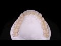 complete restoration made with prettau® 4 anterior® zirconia zirkonzahn.galleries