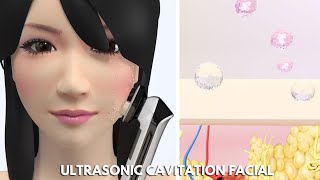 Ultrasonic Cavitation Facial | What Is Ultrasonic Cavitation Face | myChway N7