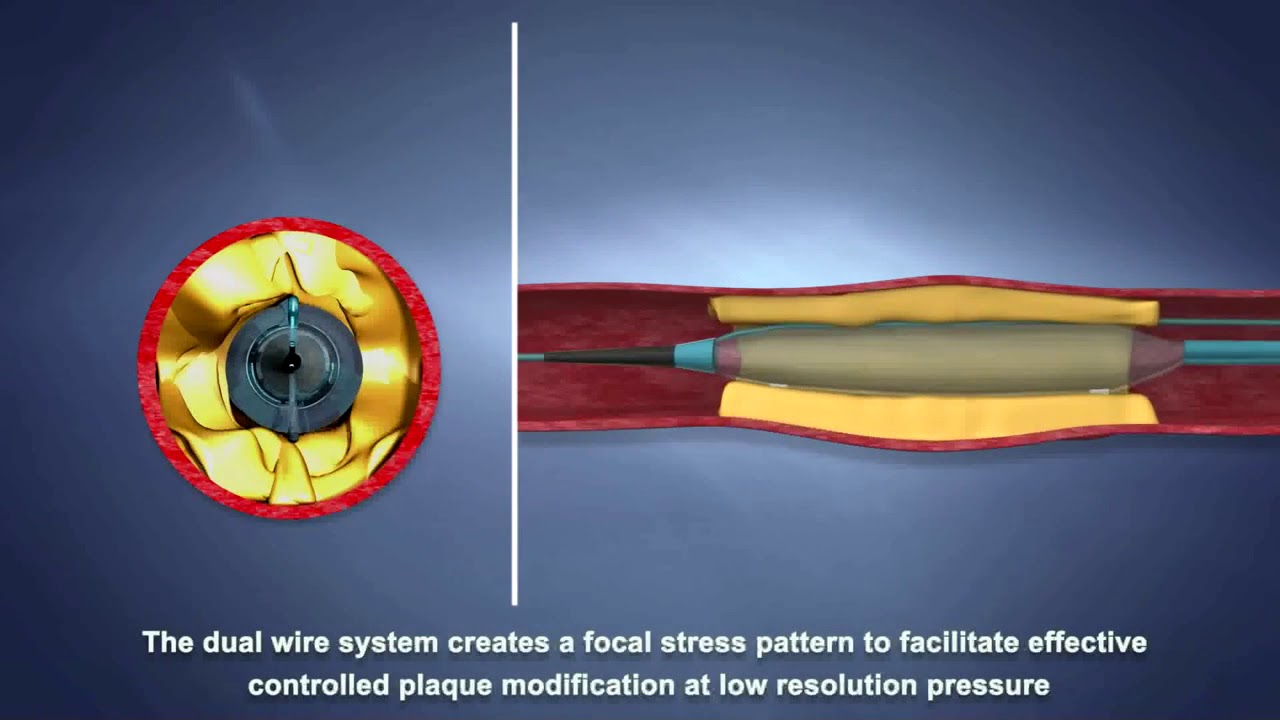 Scoreflex Balloon Youtube