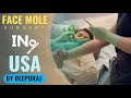 Mole surgery in USA