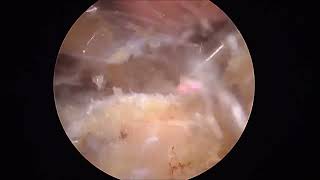 Modified Arthroscopic Latissimus Dorsi Transfer at the Infraspinatus Footprint With Anterior Extraco