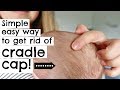 HOW TO GET RID OF CRADLE CAP IN ONE TRY! || NEWBORN