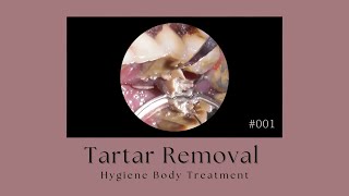 Tartar Removal 001