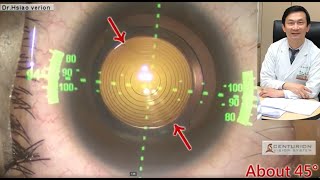 白內障手術植入高階多焦點散光人工水晶體後的軸度修正 Symfony toric IOL re-alignment and Berdahl \u0026 Hardten Astigmatism Fixation