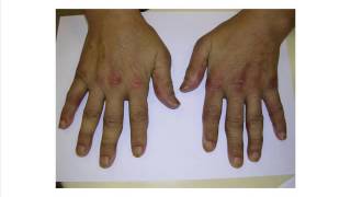 SGH Rheum Rapid Review Series - Idiopathic Inflammatory Myopathies