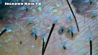 Ingrown Hair Removal from High Zoom in Black Spots with Pimples