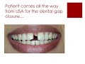 gap closure treatment at dr. kathuria s dentistry