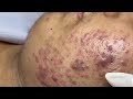 Acne Treatment Bo Nguyễn | Acne On Teen Cheek 2024