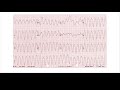 vt vs. svt with aberrancy for do md np pa part 6