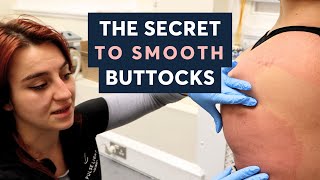 Shocking Stretch Marks Removal Transformation With Cool Laser