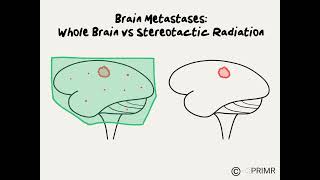 Brain Radiation versus Stereotactic Radiosurgery for Brain Metastases