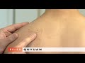 How to Locate Acupuncture Points (SI13)