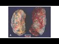 pathology specimen poly cystic kidney