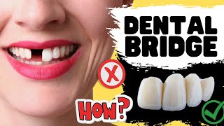 Dental Bridge Procedure for Missing Teeth { IN DEPTH Review of Risks \u0026 Benefits}