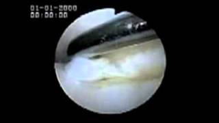 Osteochondral Defect | Osteochondral Defect Treatment of the Knee | SIMON MOYES