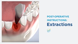 Post-Operative Instructions: Extractions at Oral Surgery Services, Metairie, LA