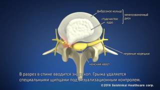 Микроэндоскопическая дискэктомия