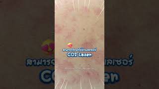 กำจัดกระเนื้อ รักษากระเนื้อด้วยเลเซอร์ | CO2 Laser | โดย คริสตัลคลินิก มหาสารคาม  #กระเนื้อ #เลเซอร์