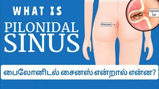 பைலோனிடல் சைனஸ் என்றால் என்ன ?what is pilonidal sinus?