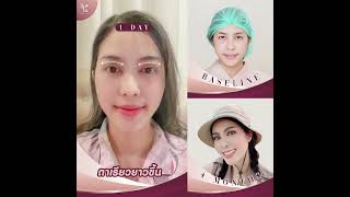 Review ตาสองชั้นเทคนิคกรีดสั้น ปรับกล้ามเนื้อตา พร้อมเปิดหัวตา แค่ 4 เดือนเข้าที่ สวยสุดๆ