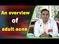 An overview of adult acne by Dr.Amit Vij | पिंपल के प्रकार, कारण और उपाय