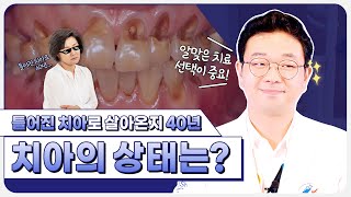 [틀어진치아] 틀어진치아 부정교합 방치 40년 된 치아 미니쉬 솔루션으로 해결 [미니쉬치과병원]