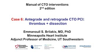 Case 6: Manual of CTO Interventions - OCT for thrombus and dissection