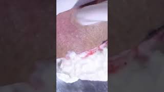 pov: you’re dr lee and it’s ⚠️ pimple popping time ⚠️ #shorts #drpimplepopper