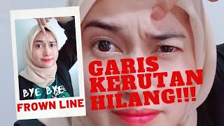 [TUTORIAL] GARIS KERUTAN HILANG  | BYE BYE FROWN LINES CARA OLGATOJA